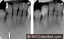 Root canal infection shown in an x-ray as periapical pathology.