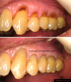 Class 5 cosmetic bonding at gum line