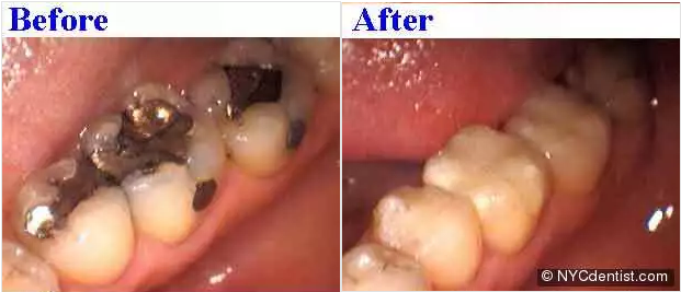 cosmetic dentistry changes silver fillings to white fillings.