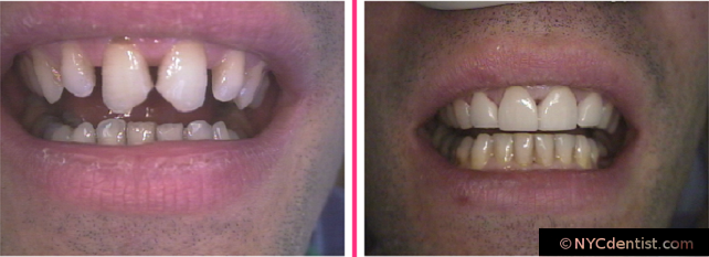Four Upper Porcelain Veneers & Sculpting or Reshaping the Lower Front Teeth in two office visits.