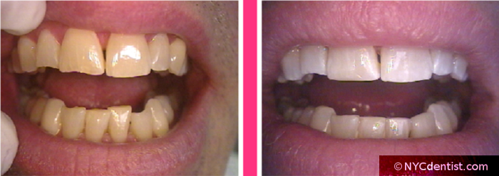 Sculpting or Teeth Reshaping, Whitening and Cosmetic Bonding