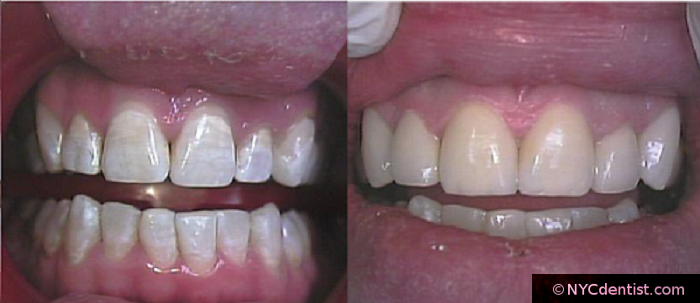 Resin bonding increases tooth length for short teeth