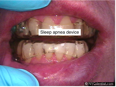 Sleep apnea treatment device, Mandibular Advancement Device MAD or OAT for Occlusal Appliance Therapy