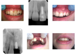Dental implant front tooth infection