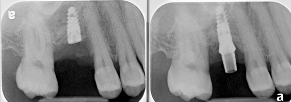dental implants stage 1, 2 explained